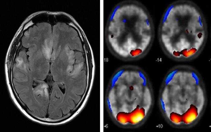 MRT-Gehirnscan einer Encephalitis (Entzündung des Gehirns) © NeuroCure