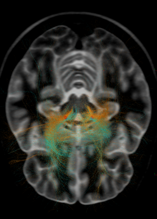 Darstellung von Fasertrakten, die durch Stimulation des subthalamischen Kerns i.R. tiefer Hirnstimulation zur Behandlung von Parkinson moduliert werden. ©  Dr. med. Andreas Horn